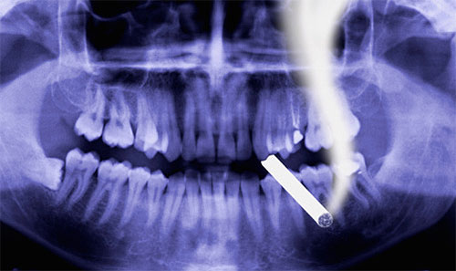 Болезни зубов от курения